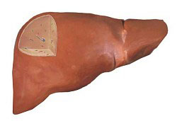 脂肪肝:“沉默”的器官需要“减肥”