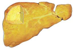 脂肪肝:“沉默”的器官需要“减肥”