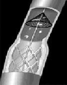 颈动脉支架放置过程中应用保护伞