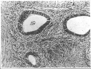 子宫内膜异位症