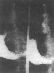 食管裂孔疝(外科)