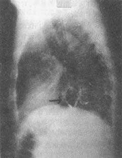 食管裂孔疝(外科)