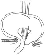 食管裂孔疝(外科)