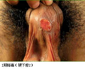 梅毒的临床表现(图)