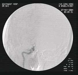 ȱѪ����Ѫ�ܲ���֧Ѫ�ܲ���֧��ֲ�����ƵĿ�����̽�������/��·��/��ѡ���Զ����ڰ�����˨///