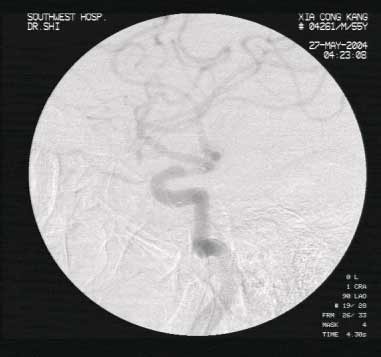 ȱѪ����Ѫ�ܲ���֧Ѫ�ܲ���֧��ֲ�����ƵĿ�����̽�������/��·��/��ѡ���Զ����ڰ�����˨///