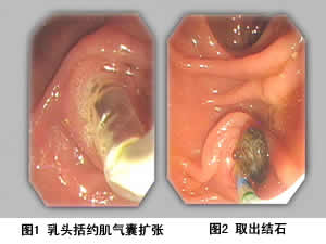 ���ܹܽ�ʯ���ھ�����/�ھ�����ͷ��Լ���п�ȡʯ/�ھ��»�е��ʯ/��������ʯ(ESWL)/����ˮѹ��ʯ(EHL)/�ھ��¼�����ʯ/��ͷ��Լ�����ź�ȡʯ/