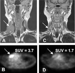 FDG-PET�����ڽ�չ���ܰ���������Ч�ļ��//����/