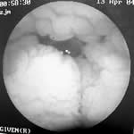 ˫��֫ˮ�ף��Ͱ׵���Ѫ֢/����ժҪ/