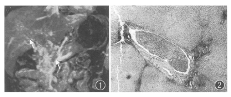 ��ά��Ӱ����ǿ�Ź���Ѫ�ܳ����׼ȷ�жϸΰ��ַ�����//