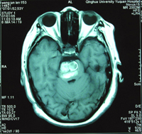 �������������Կ�ҽԺ�ɹ��г��޴��Ըɺ���״Ѫ����//