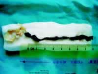 ��������ȡ��һ���ڶ�����Ѫ˨//