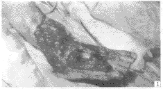 Ӧ��Ƥ�ꡢ��Ƥ���޸�С�ȼ����ײ�Ƥ������֯ȱ������¶