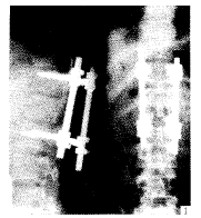 ˫������ѹRF�ڹ̶�����������׵�屬�ѹ���