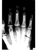 ţ�ǹ������ֲ������е�Ӧ��