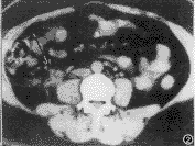 ������ʯ����������γ�