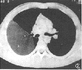 ��ǻ�޴�֬����һ��