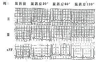 �ĵð�������ʶ������ST-T�ı���ٴ�����