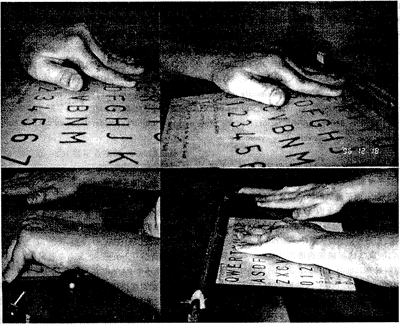 New Hope for Life:Acupuncture Relieves 10 years Frozen Hands