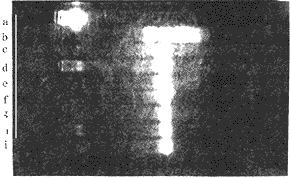 �ߵ��̴�Ѫ֢������֬����B-100ȱ�ݵļ��