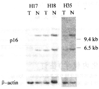 �˸ΰ���p16��CDK4������Ŵ����켰����HBV��Ⱦ֮��Ĺ�ϵ