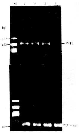 ��Ѫ������WT1����ı��Ｐ���ٴ�����
