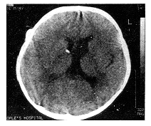 CT���嶨����ǻ�ڷ�����������­�ʹ���