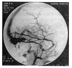 �����Ӳ��Ĥ������������ϼ�����̽��