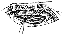 ��Ĥ������������ڶ�������