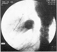 Amplatzerɡ˨�������ƶ�������δ�ղ���������1��