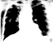 �����Է��׵�X�ߺ�CT���