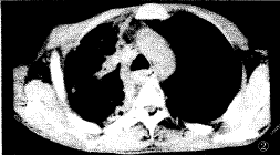 �����Է��׵�X�ߺ�CT���