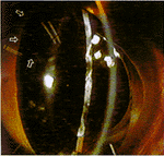 �鳤�ද��ֲ���ͪע��ʽ��״�岢����Ĥ����պ�ĵ��ڷ���