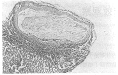 ���߹�������С������Ĥ����ֲ�఩ģ�͵Ľ���