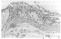 ���߹�������С������Ĥ����ֲ�఩ģ�͵Ľ���