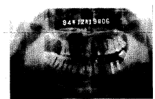 X��Ӱ���ڿ�ǻ����ֲ���е�����