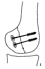 ���ʹ��ݶ����ƹɹǺ�������