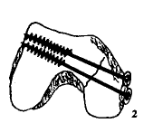 ���ʹ��ݶ����ƹɹǺ�������