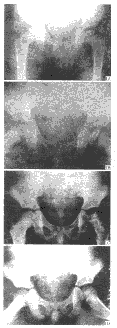 ţ����̬�������׼������Ĺ�ֲ�����ƶ�ͯ�ɹ�ͷȱѪ�Ի���