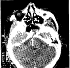 ���ǵ���·��΢�����޲���ͻ-б�²�ȱ�������Լ�Һ��©