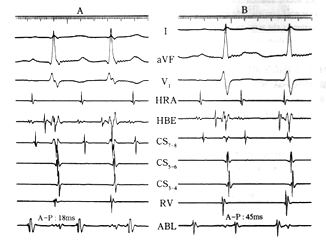 Դ�ڷξ����ڲ��ķ����Ķ�����P������̬����Ƶ��������
