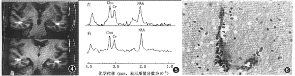 ����Ӳ��MR���Ӳ��׷�����MRI�ĶԱ��о�