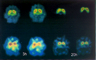 ��������ɭ��123I-��-CIT��SPECT�����о�