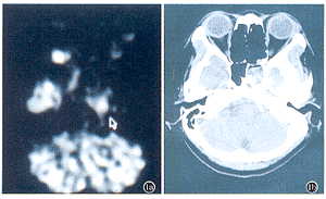 <sup>18</sup>F-FDG PET��ͷ���������ƺ󸴷��е�Ӧ��