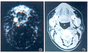 <sup>18</sup>F-FDG PET��ͷ���������ƺ󸴷��е�Ӧ��