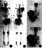 ���ع�����׵�塰С���桱�����Paget��һ��