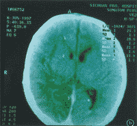 ������ȱ��ȱѪ���Բ�SPECT��������CTɨ��ĶԱȷ���