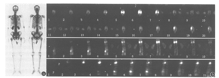 SPECT����������±���������ٴ���ֵ