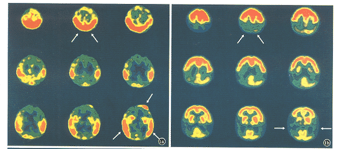 ��ͯ����������<sup>99</sup>Tc<sup>m</sup>-ECD SPECT��Ѫ��������о�