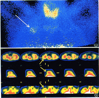 <sup>99</sup>Tc<sup>m</sup>-MIBI�������Χ�Է���������ϼ�ֵ